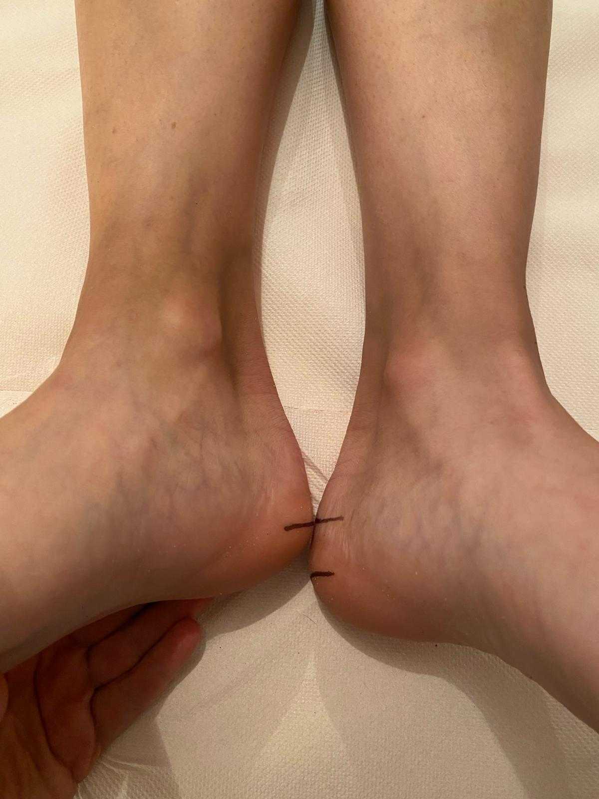 fotografija prije ispravljanja kraljeznice