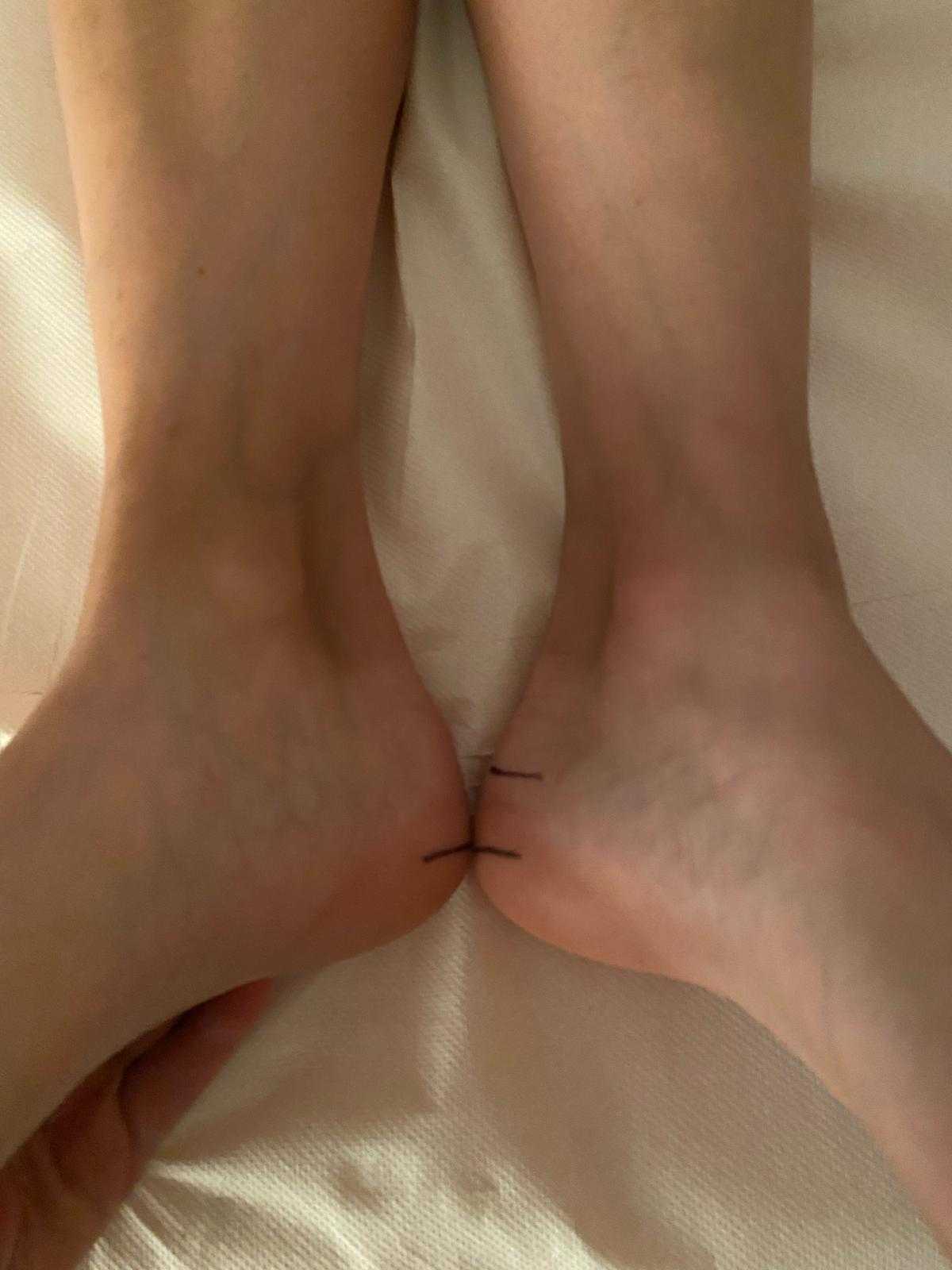 fotografija nakon ispravljanja kraljeznice